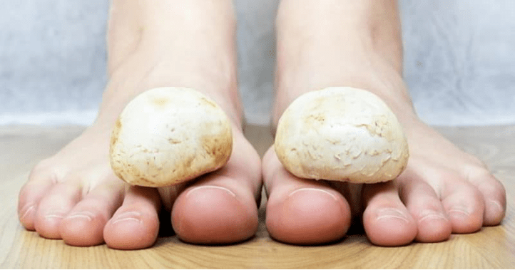 Trattamento rapido dei funghi sulle gambe di casa