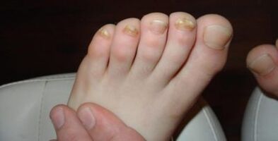 I tricofiti sono rossi