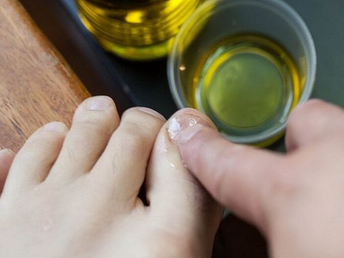 Applicare olio medicato sulle unghie colpite dai funghi