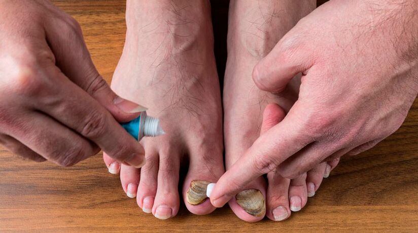 Applicazione di una crema antifungina sulle unghie dei piedi per trattare l'onicomicosi